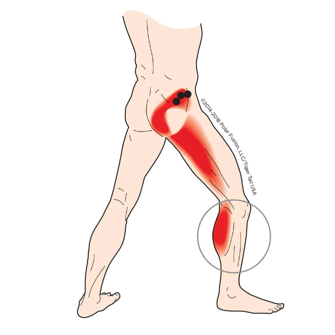MuscleEducation_GluteusMinimusPosteriorPortion_7-8