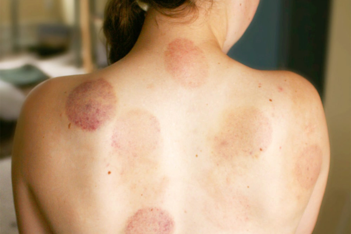 What You Need To Know: Cupping
