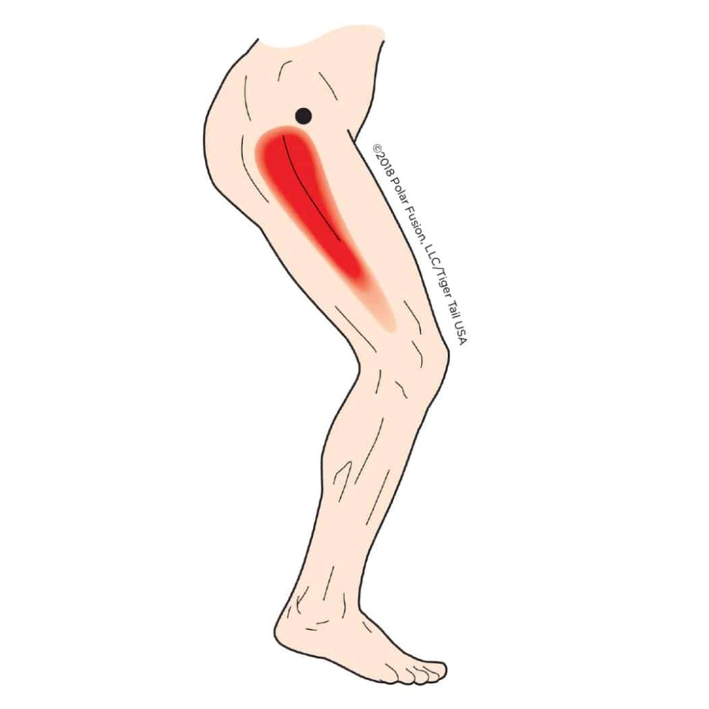 MuscleEducation_TensorFasciaeLatae_3-3