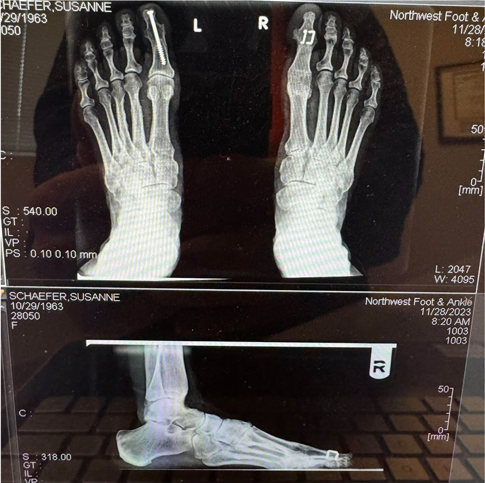 Sue Schaefer Foot surgery