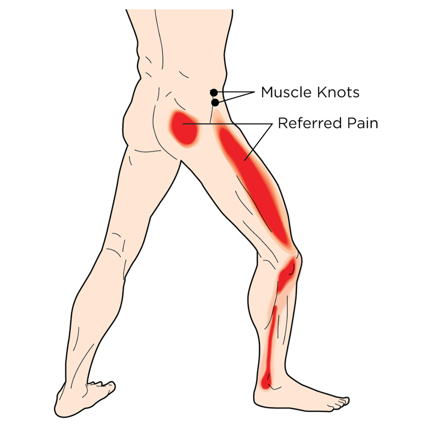 Referred pain is pain that's felt in an area other than where the source of the pain is located. Muscle knots, also known as trigger points, can cause referred pain.