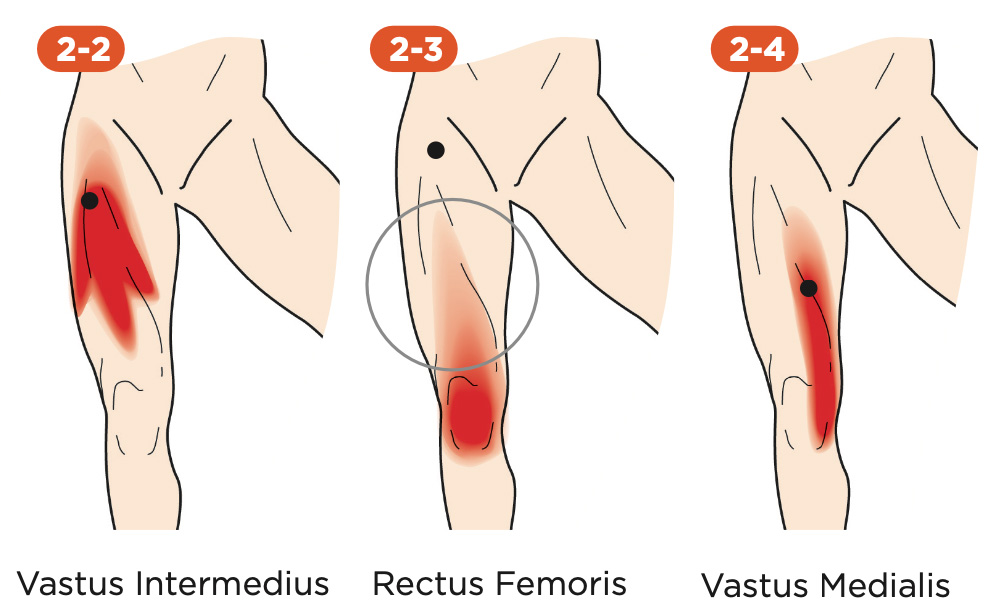 MuscleKnots_Quads_web Muscle Knots in Quadriceps