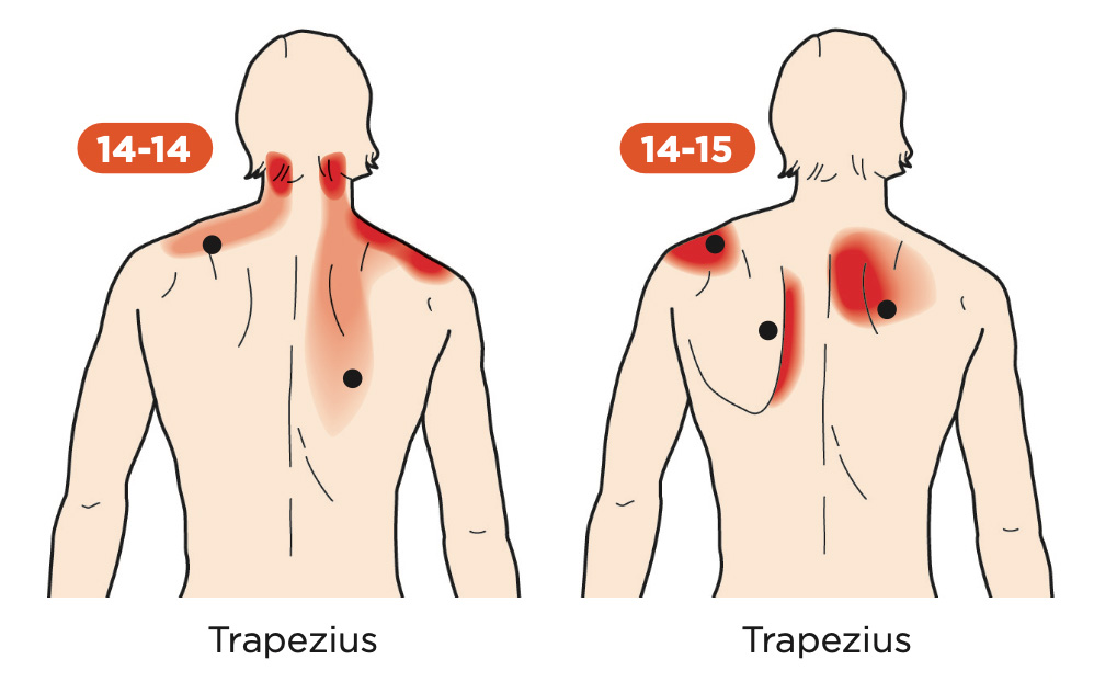 MuscleKnots_Shoulder_web Muscle Knots in the Shoulder
