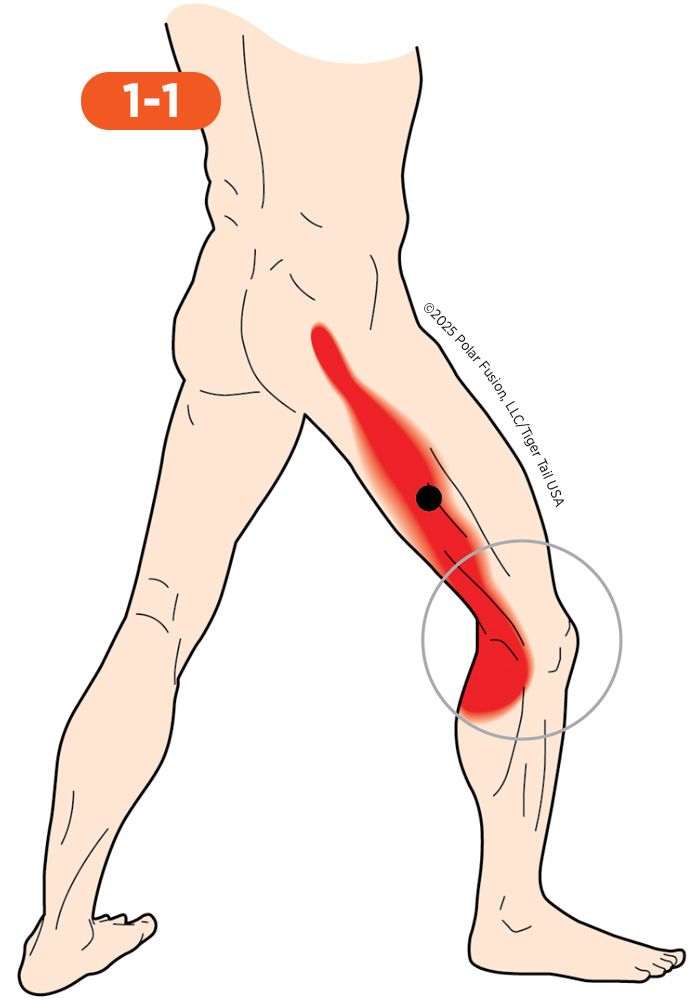 Knee_Back_1-1_VastusLateralis_700px Back of Knee Pain 1-1 Vastus Lateralis