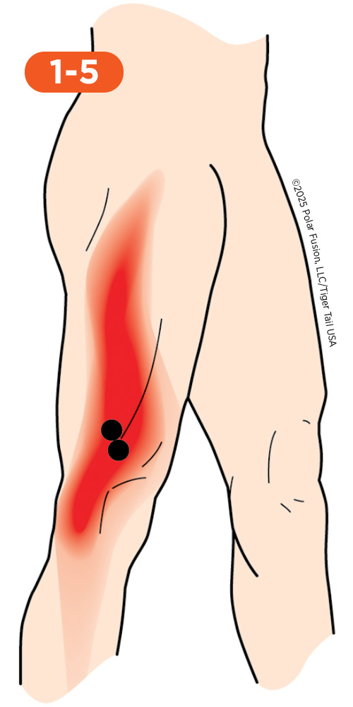 Knee_Front_1-5_VastusLateralis_500px Front of Knee Pain 1-5 Vastus Lateralis