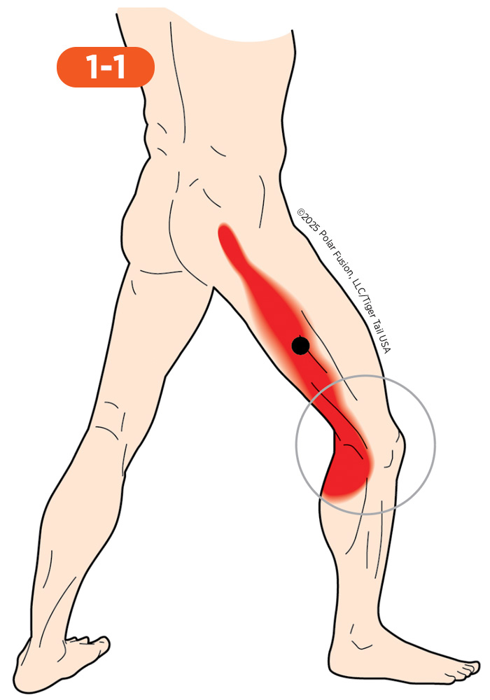 Knee_Side_1-1_VastusLateralis_700px Side of Knee Pain 1-1 Vastus Lateralis