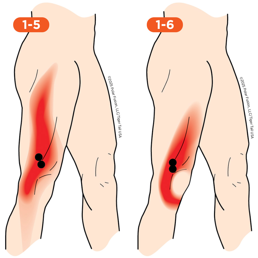 Knee_Side_1-5_1-6_VastusLateralis_1000px Side of Knee Pain 1-5 1-6 Vastus Lateralis
