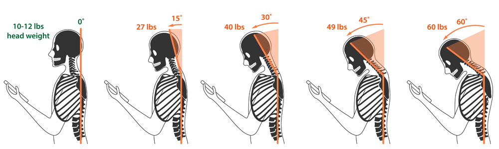 Tech Neck - chronic neck and shoulder pain, stiffness, and soreness that results from prolonged poor posture while using electronic devices such as smartphones