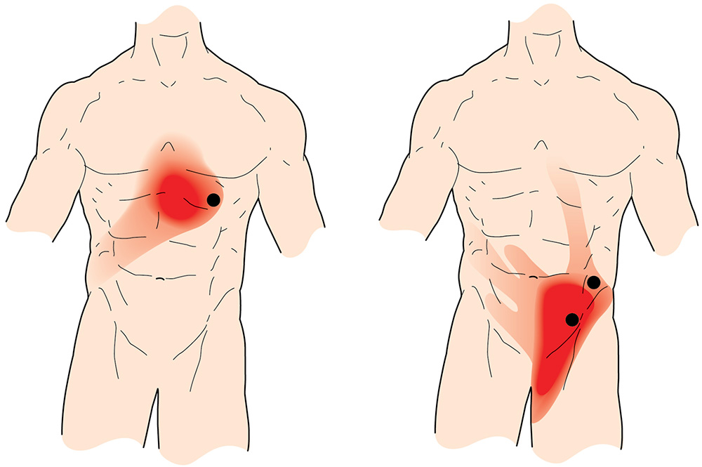 Abdominal Pain Muscle Knots Abdominus Obliqui