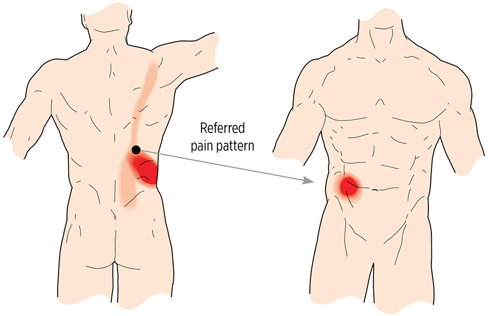 Abdominal Pain Muscle Knots Iliocostalis Thoracis