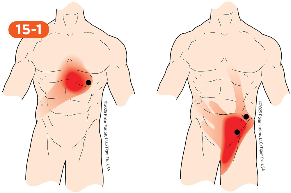 Abdominal Pain 15-1 Abdominus Obliqui