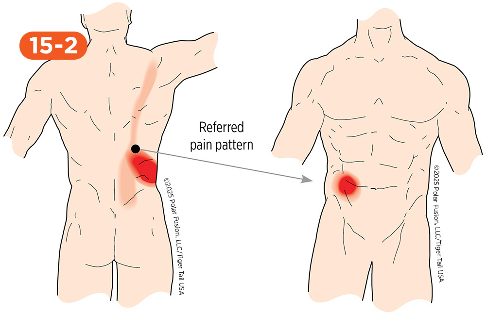 Abdominal Pain 15-2 Iliocostalis Thoracis