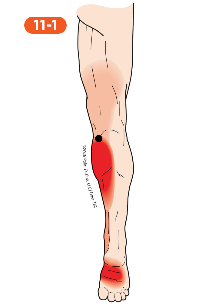 Achilles Pain 11-1 Gastrocnemius