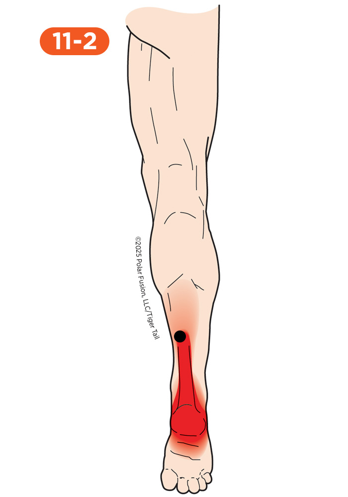Achilles Pain 11-2 Soleus