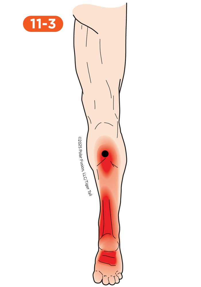 Achilles Pain 11-3 Tibialis Posterior