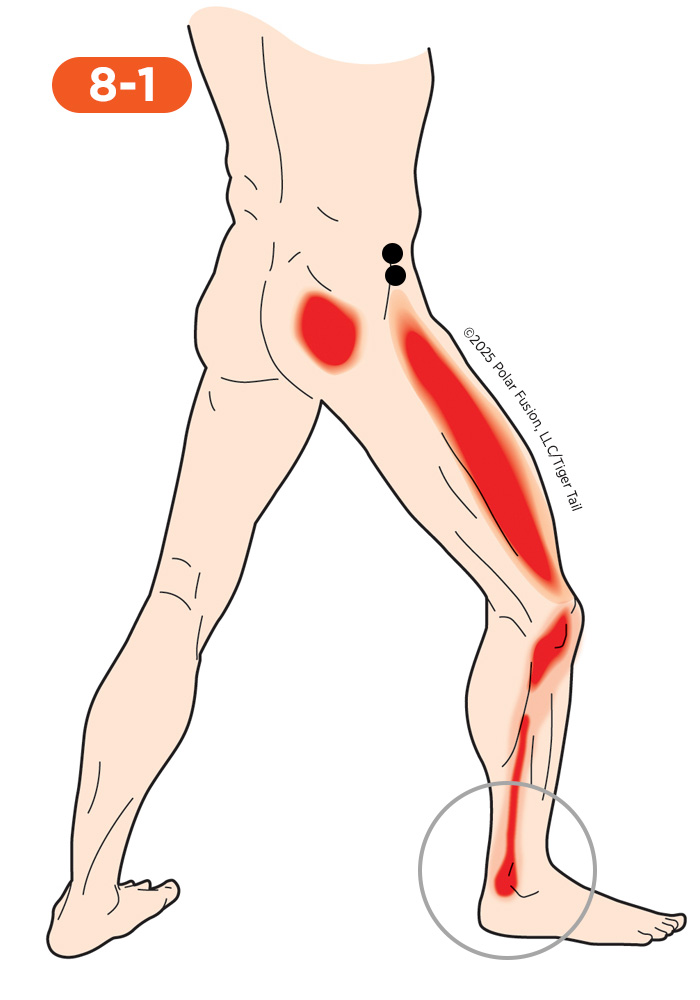 Ankle Pain 8-1 Gluteus Minimus Anterior Portion