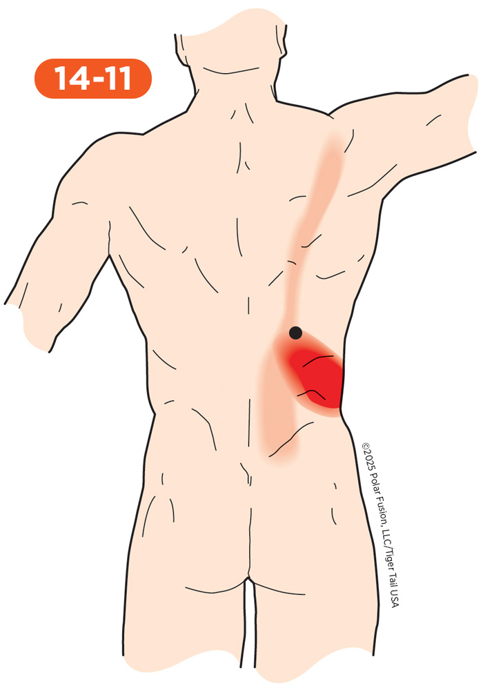 Back Pain 14-11 Iliocostalis Thoracis Caudal Portion