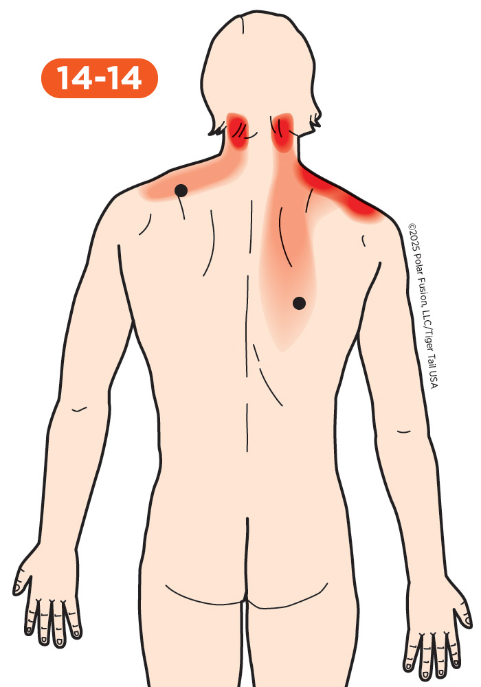 Back Pain 14-14 Trapezius