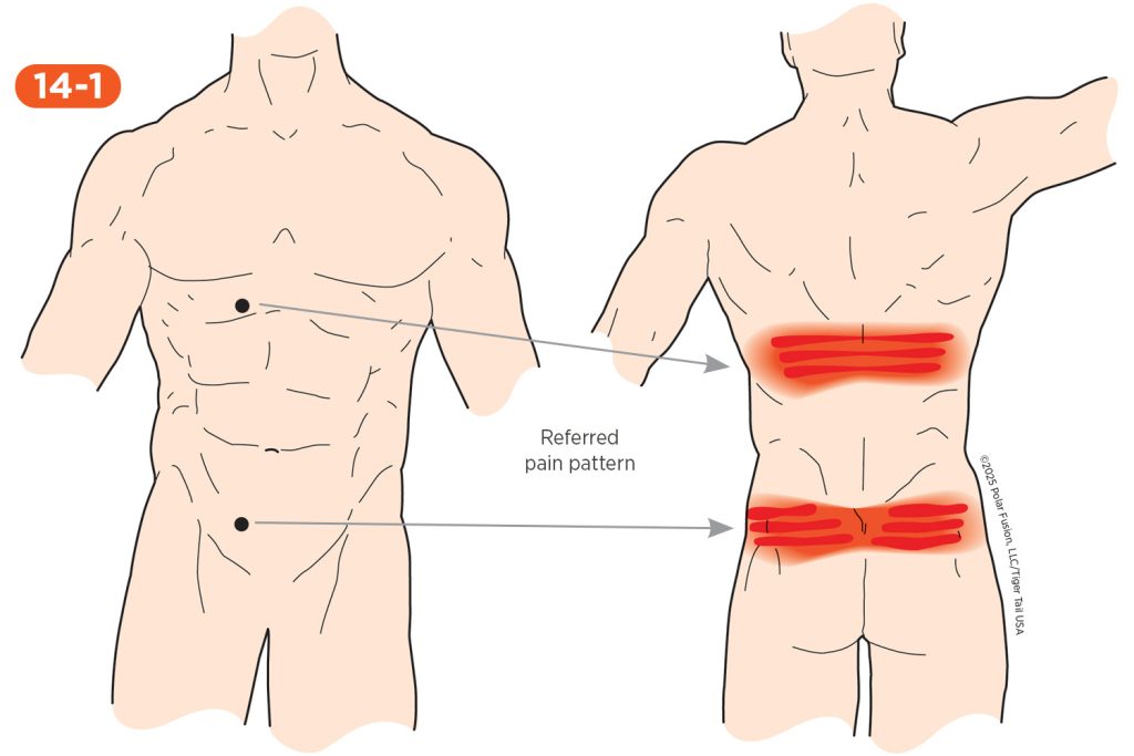 Back Pain 14-1 Rectus Abdominis