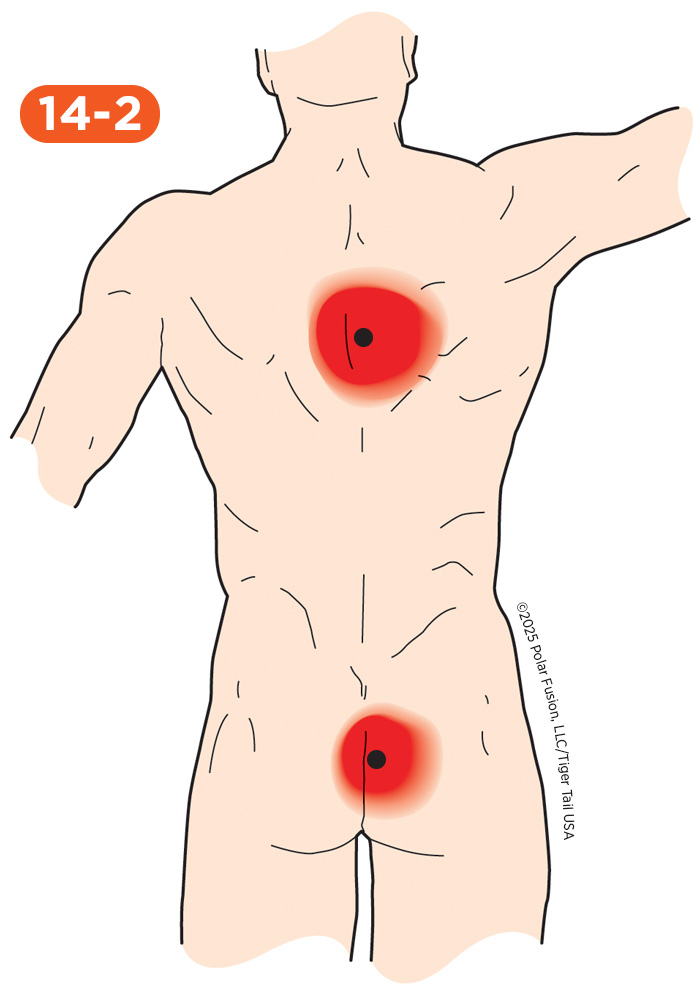 Back Pain 14-2 Multifidi Rotatores Semispinalis