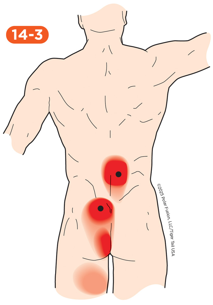 Back Pain 14-3 Multifidi Rotatores Semispinalis