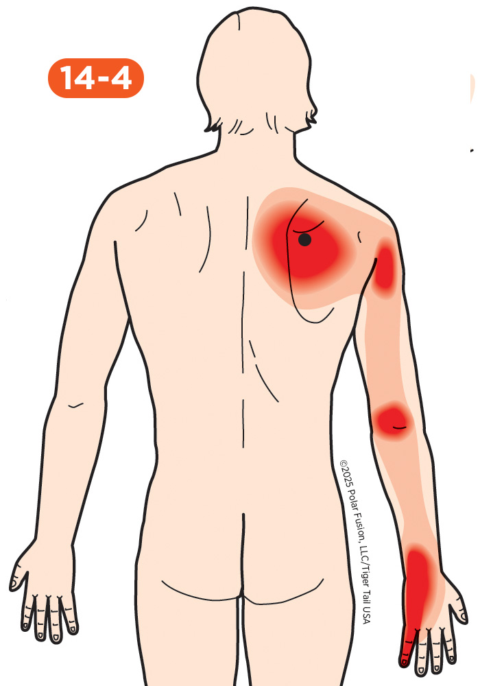 Back Pain 14-4 Serratus Posterior Superior