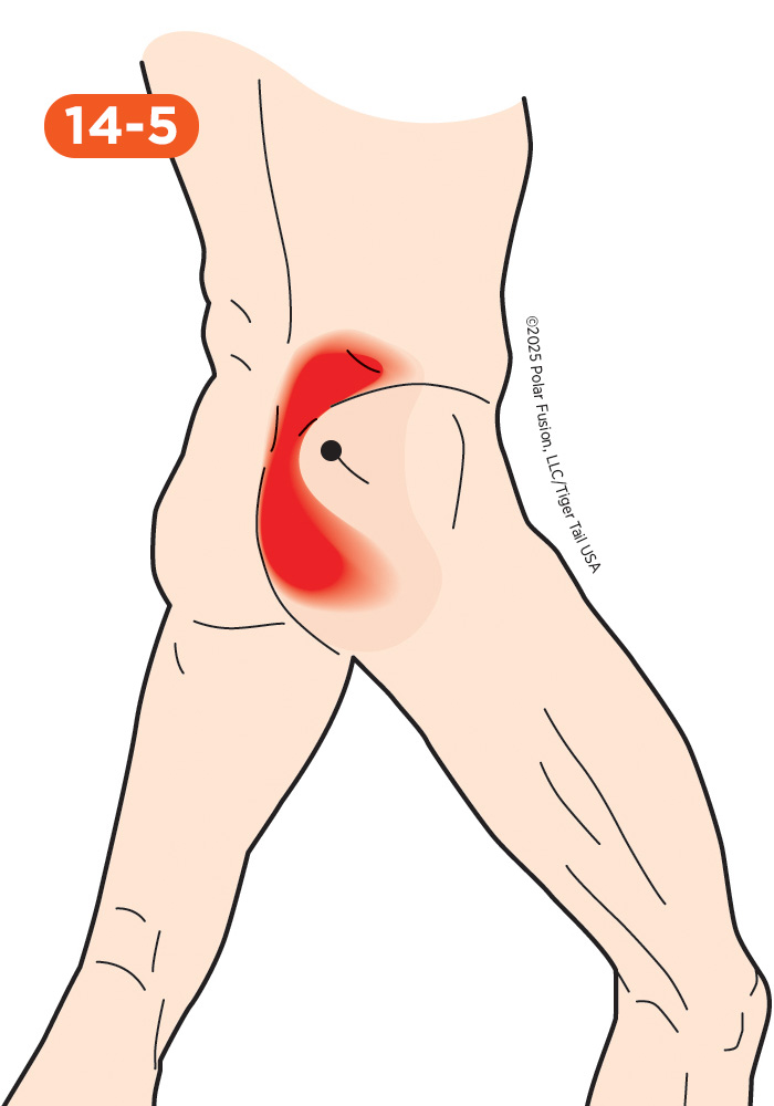 Back Pain 14-5 Gluteus Medius