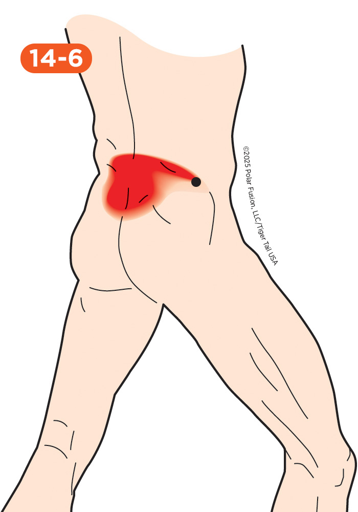Back Pain 14-6 Gluteus Medius
