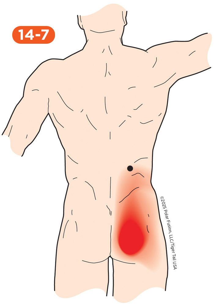 Back Pain 14-7 Iliocostalis Lumborum