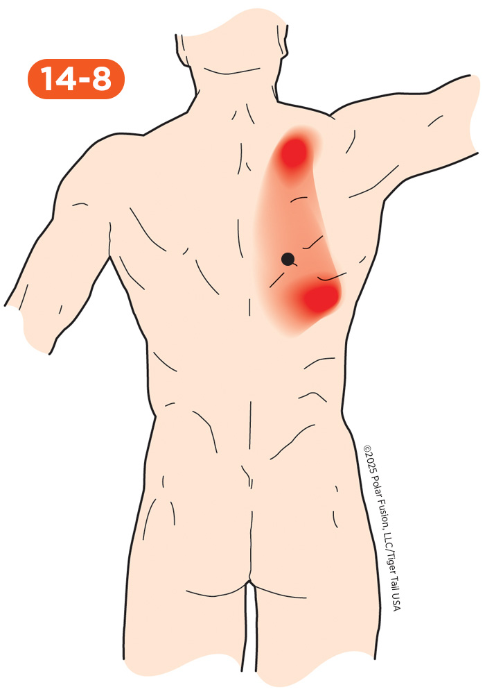 Back Pain 14-8 Iliocostalis Thoracis Mid-Level