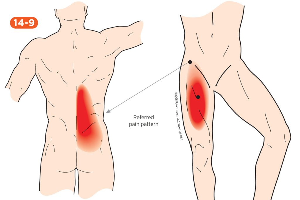 Back Pain 14-9 Iliopsoas