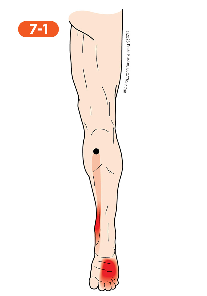 Calf Pain 7-1 Flexor Digitorum Longus