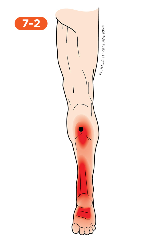 Calf Pain 7-2 Tibialis Posterior