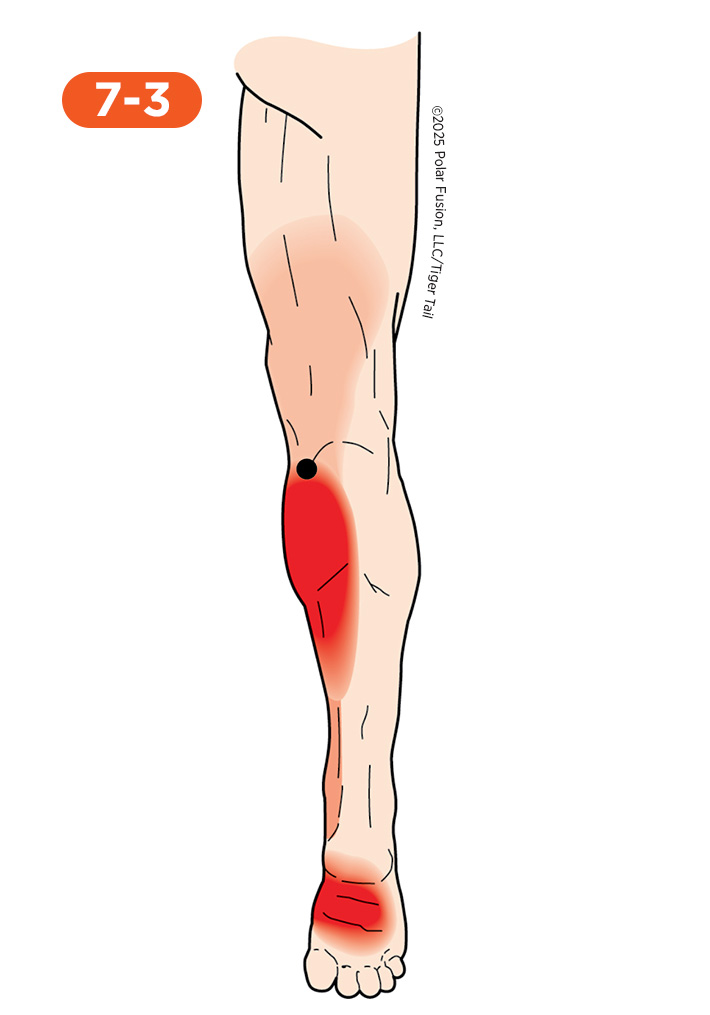 Calf Pain 7-3 Gastrocnemius