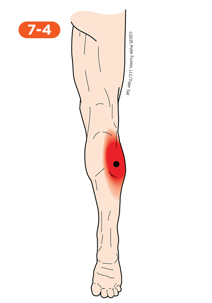 Calf Pain 7-4 Gastrocnemius
