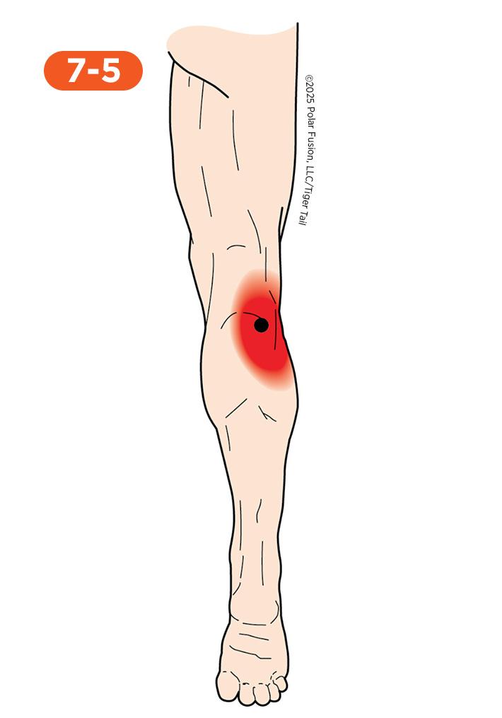 Calf Pain 7-5 Gastrocnemius