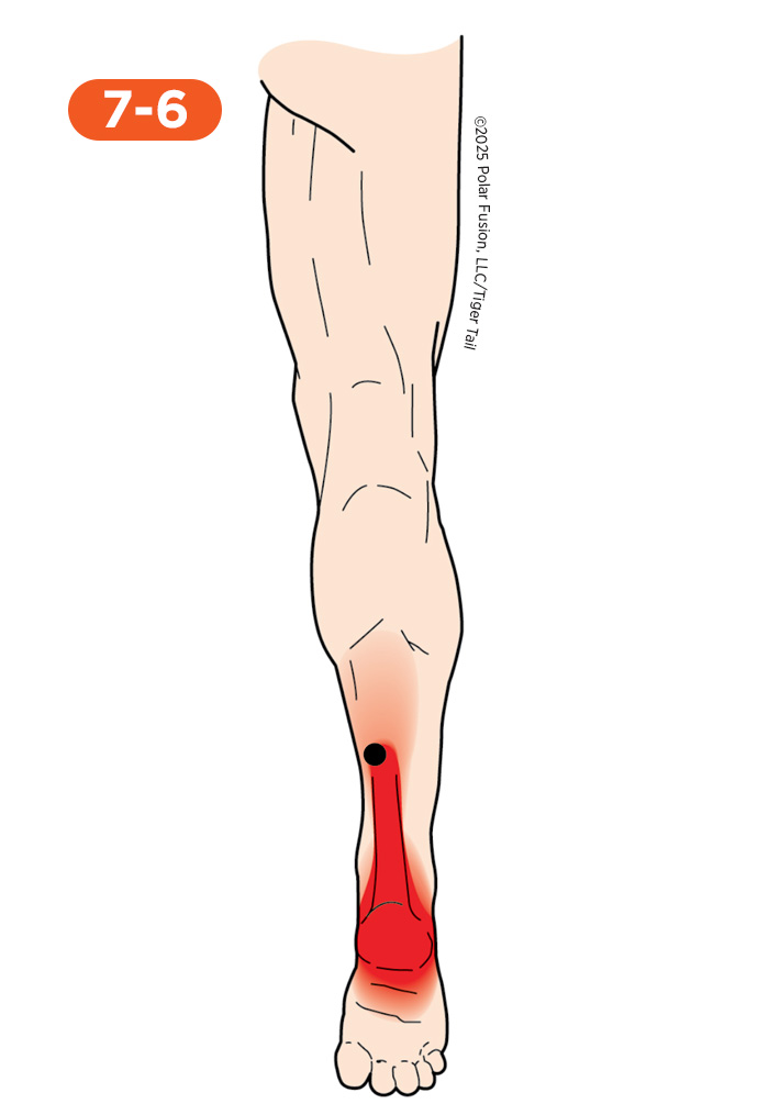 Calf Pain 7-6 Soleus