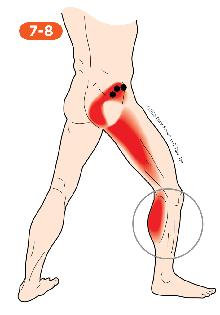 Calf Pain 7-8 Gluteus Minimus Posterior Portion