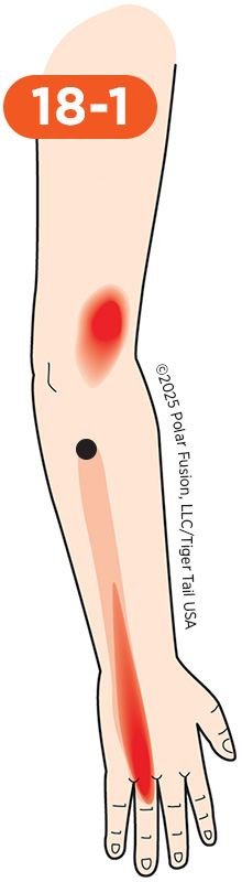 Elbow Pain 18-1 Ring Finger Extensor