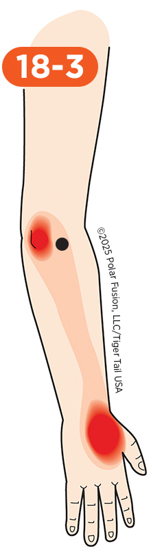 Elbow Pain 18-3 Extensor Carpi Radialis Longus