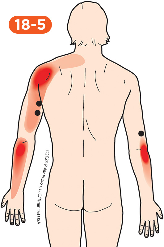 Elbow Pain 18-5 Triceps Brachii