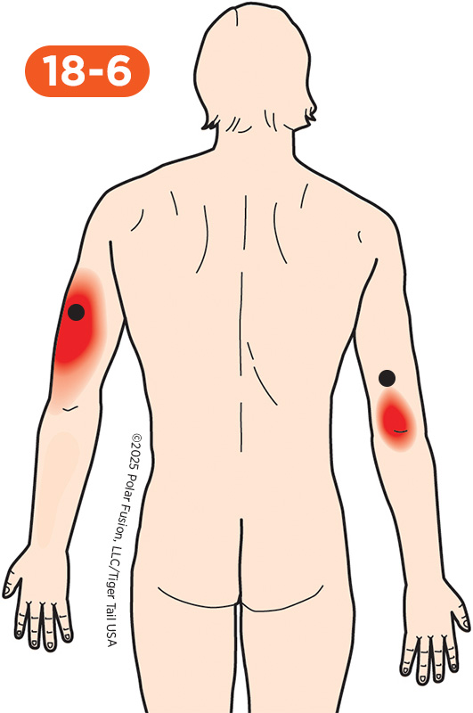 Elbow Pain 18-6 Triceps Brachii