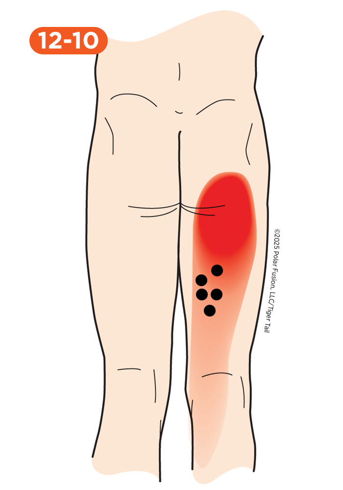 Glute Pain 12-10 Semitendinosus