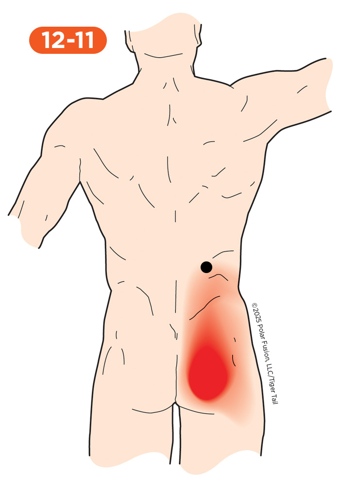 Glute Pain 12-11 Iliocostalis Lumborum