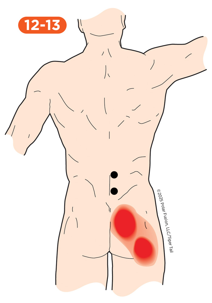 Glute Pain 12-13 Quadratus Lumborum