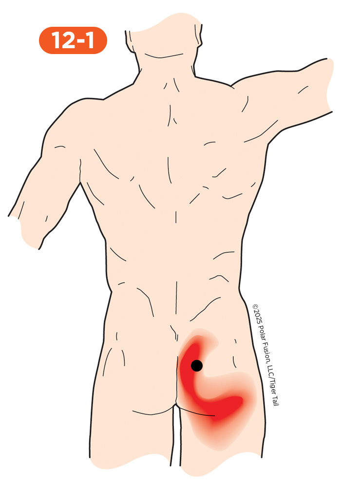 Glute Pain 12-1 Gluteus Maximus