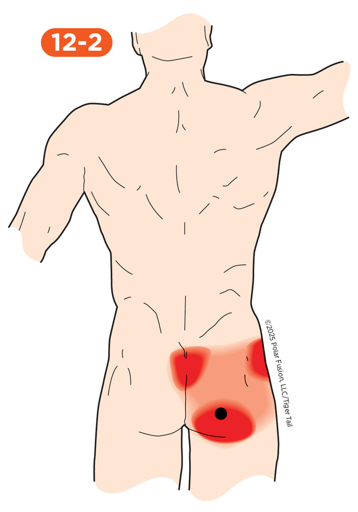 Glute Pain 12-2 Gluteus Maximus