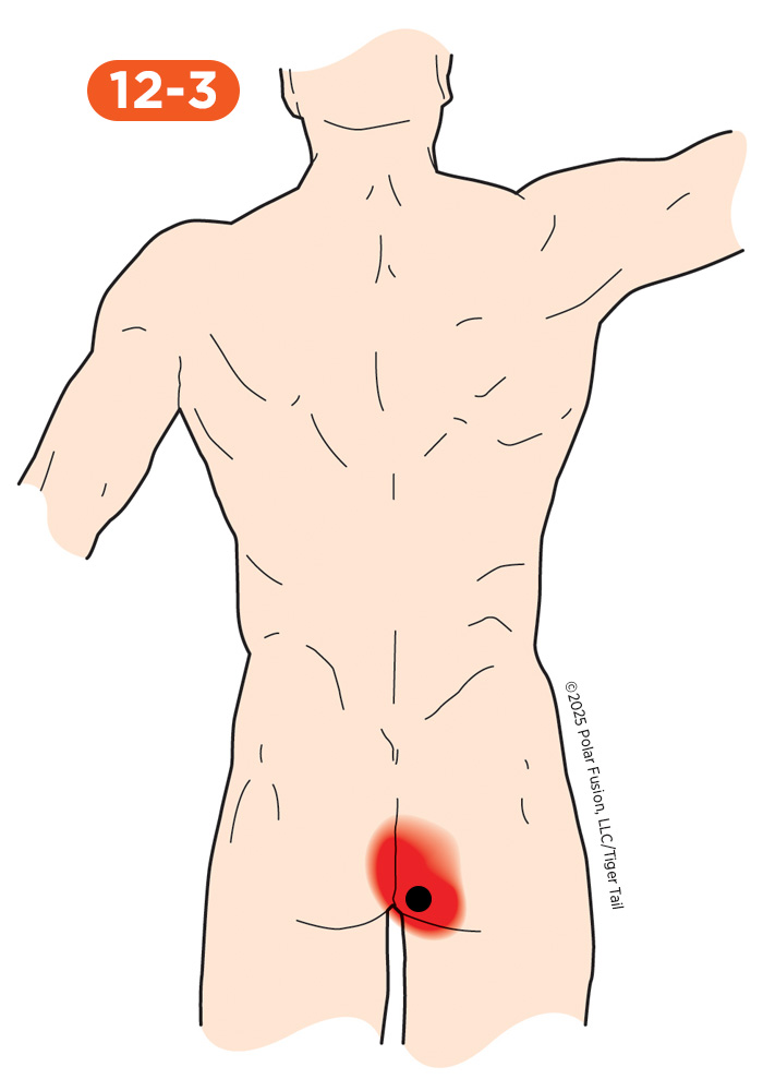Glute Pain 12-3 Gluteus Maximus