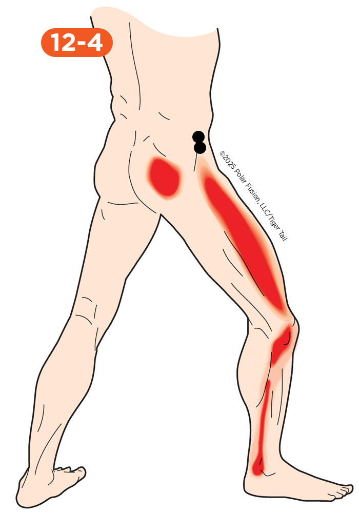 Glute Pain 12-4 Gluteus Minimus Anterior Portion