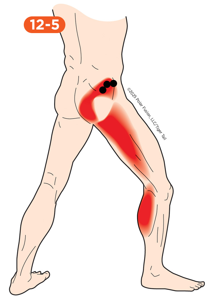 Glute Pain 12-5 Gluteus Minimus Posterior Portion